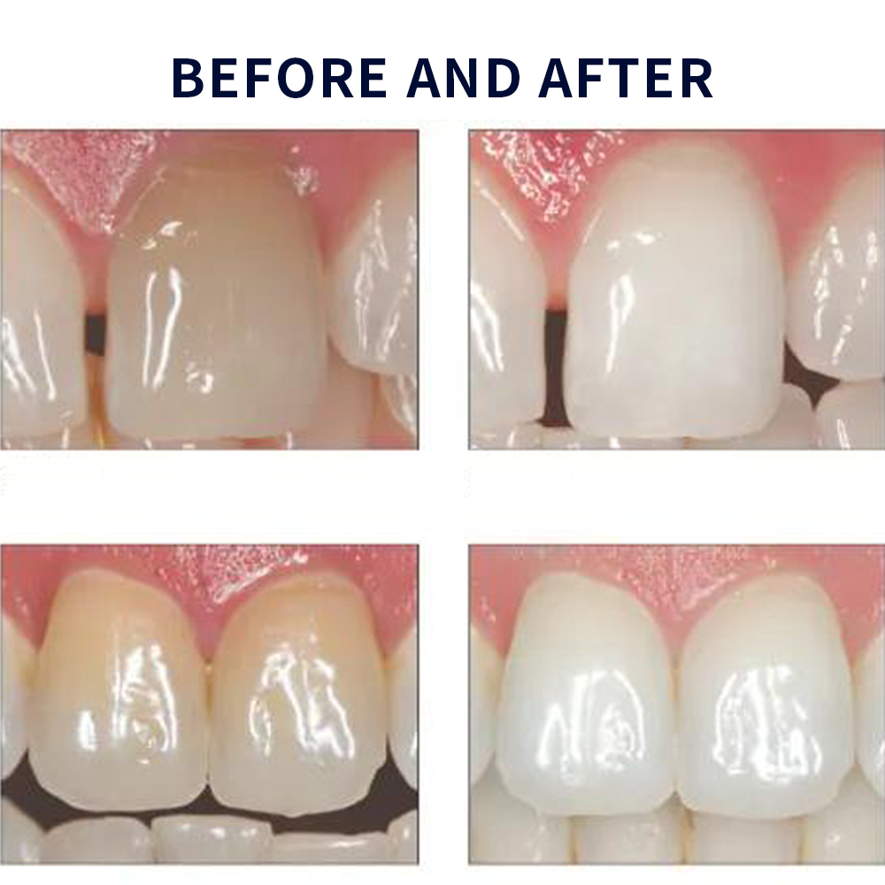 Opalescence Whitening 20% PF 2 - Teeth Whitening Remedies ulasan dan harga
