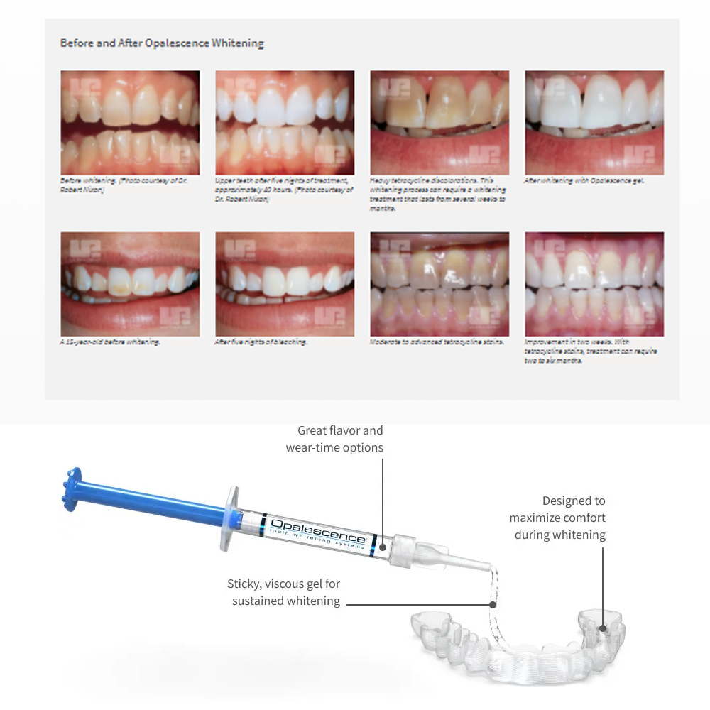 Opalescence Whitening 20% PF 2 - Teeth Whitening Remedies ulasan dan harga