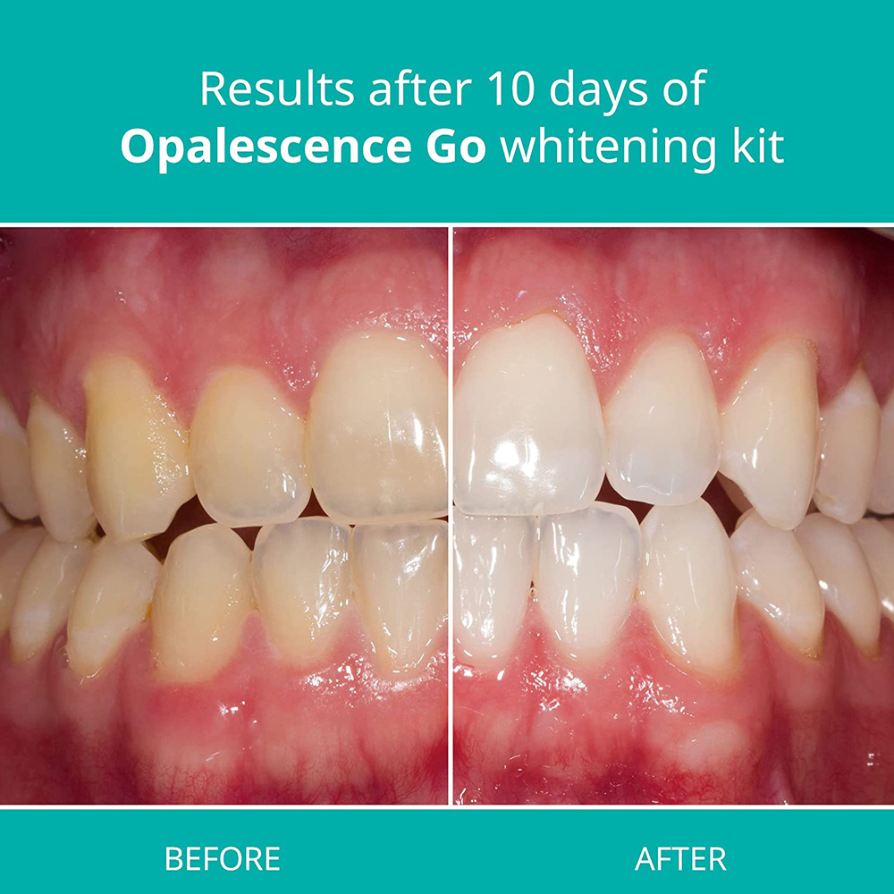 Opalescence Go Teeth Whitening - Teeth Whitening Opalescence ulasan dan harga